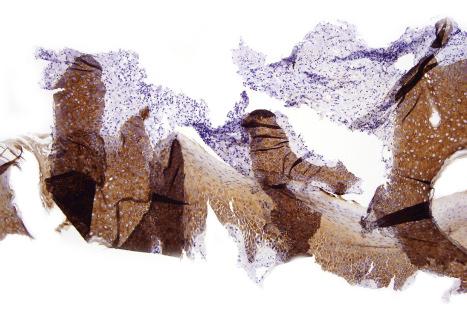 Fig. 2.12, Technical artifact: poor tissue fixation resulting in incomplete sections, fragmentation, and suboptimal AE1/AE3-stained sections.