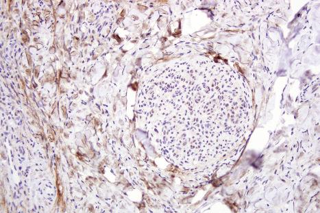 Fig. 2.13, Technical artifact p53 stain: wrinkling and background staining of tissue sections because of erroneously high temperature heat-assisted microwave antigen retrieval exposure of sections in EDTA buffer (pH 8.0).