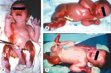 Fig. 2.17, Clinical appearances of neonates with different forms of inherited EB. All three cases have similar blisters and erosions but their respective prognoses differ considerably. ( A ) Severe, generalized recessive dystrophic EB; ( B ) Dowling-Meara EB simplex; ( C ) Herlitz junctional EB. Skin biopsy is fundamental to establishing the subtype of severe forms of EB.