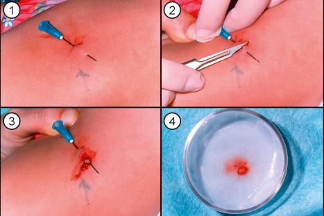 Fig. 2.18, Optimal skin biopsy for diagnosing EB: following local anesthesia, the normal-appearing skin is gently rubbed, and then a superficial shave biopsy is taken. The skin sample can then be subdivided for immunolabeling of frozen sections as well as being processed for transmission electron microscopy.