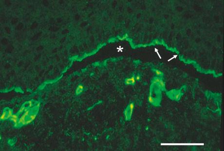 Fig. 2.19, Antigen mapping to diagnose the subtype of inherited EB: this picture shows immunolabeling of rubbed skin from an individual with EB (case illustrated in Fig. 2.17A ) with an anti-type IV collagen antibody. Rubbing the skin induces microsplits at the dermal–epidermal junction ( asterisk ). The type IV collagen reactivity maps to the roof of the dermal–epidermal junction ( arrows ). This indicates a sublamina densa plane of cleavage and establishes a diagnosis of dystrophic EB. (Bar = 25 µm.)