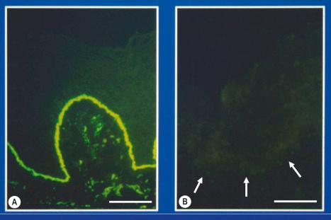 Fig. 2.20, Specific antibody probes to subtype inherited EB: ( A ) immunostaining of normal control skin with an antibody to type VII collagen shows bright linear labeling at the dermal–epidermal junction; ( B ) in contrast, the complete absence of labeling in skin from an individual with EB (case illustrated in Fig. 2.17A ) indicates a diagnosis of severe, generalized recessive dystrophic EB. (Bar = 50 µm.)