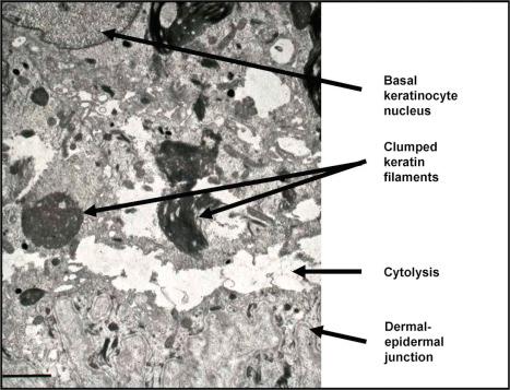 Fig. 2.21, Transmission electron microscopy of skin in Dowling-Meara EB simplex (case illustrated in Fig. 2.17B ): within the basal keratinocyte cytoplasm the keratin filaments are condensed and form clumps and there is cytolysis that occurs just above the dermal–epidermal junction. (Bar = 1 µm.)