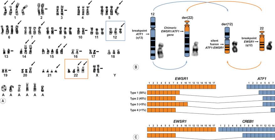 Fig. 2.22, Genetics of clear cell sarcoma: ( A ) this complicated karyotype shows derivative chromosomes 12 ( blue box ) and 22 ( orange box ). While recurrent translocation-associated karyotypes are initially simple, they can become more complex with tumor progression. ( B ) The mechanism of chromosomal translocation involves breaks in chromosomes 12 and 22 that recombine to produce novel derivative chromosomes 12 and 22. The active fusion gene ( EWSR1-ATF1 ) is produced on der(22). The fusion genes can be produced by a variety of breakpoints within the introns of the involved genes making multiple exon combinations ( C ). This complicates the design of PCR-based detection methods, as does substitution of the CREB1 gene for ATF1 on occasion.