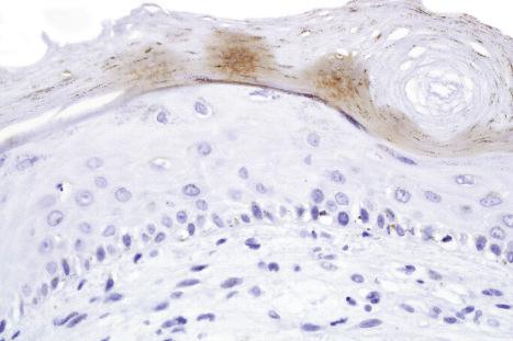 Fig. 2.10, Technical artifact: HHV8-stained sections demonstrating chromogen entrapment in stratum corneum.