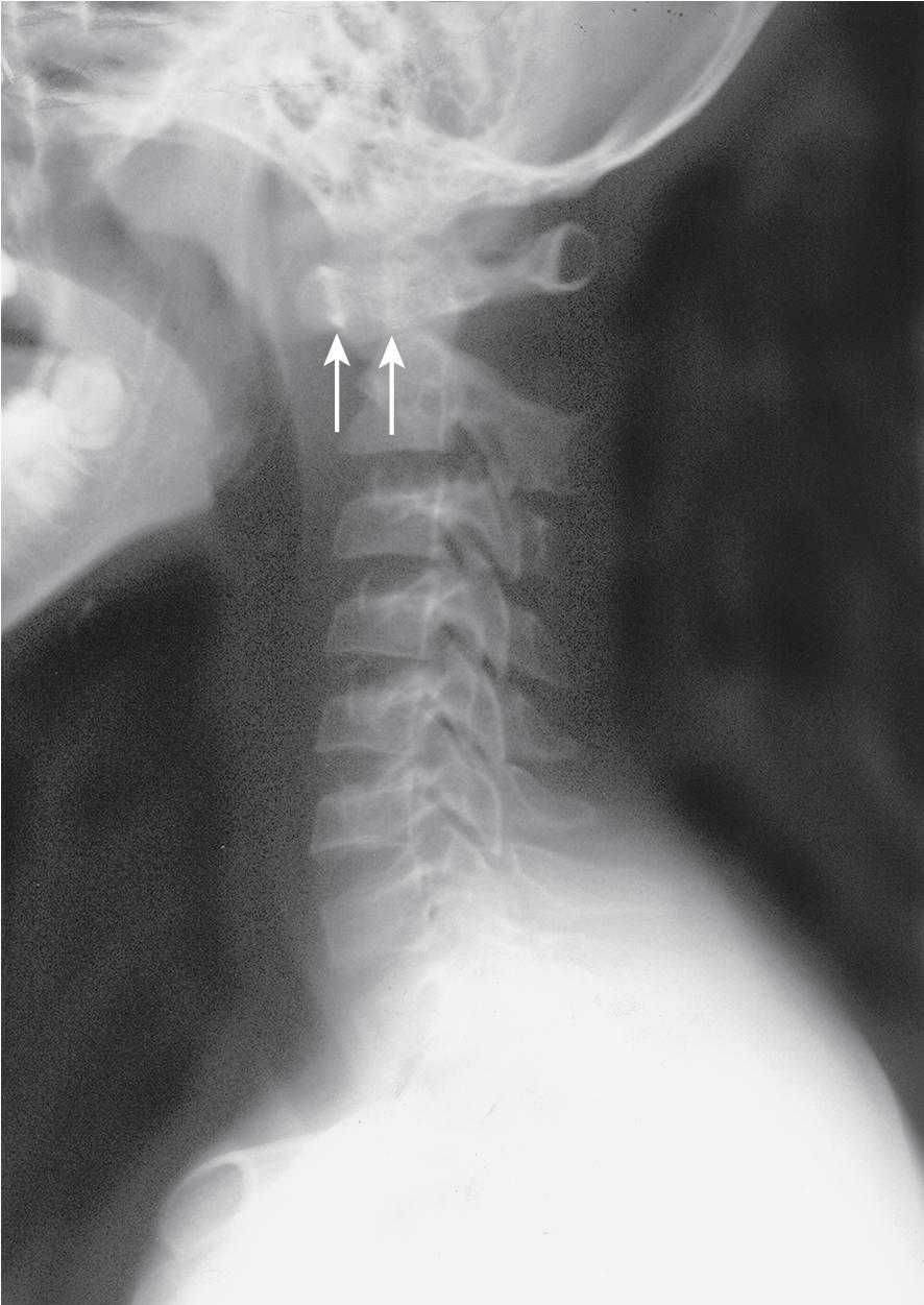 Fig. 54.1, Atlantoaxial Instability.