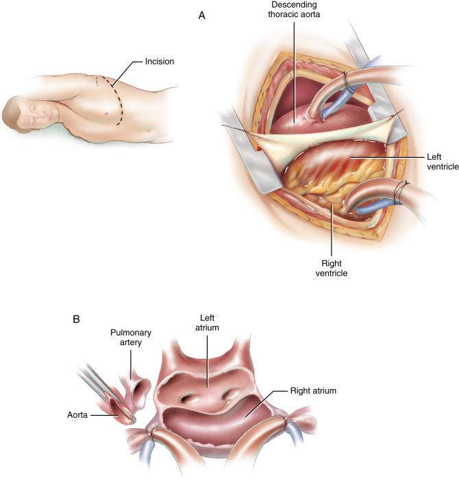 Figure 41-1, A Cardiopulmonary bypass is established by cannulation of the right ventricle with a single venous uptake cannula, with oxygenated blood returned to the descending thoracic aorta. The venous cannula is simple to insert in the dilated right ventricle through a purse-string stitch for retention. The aortic return site is conveniently located at the posterior margin of the exposure. B The body temperature is reduced to 20 o C by the usual core-cooling technique. The circulation from the bypass pump is temporarily stopped, and the venous cannula is removed. The heart is excised, and the great vessels are divided. The lateral wall of the right atrium is easily exposed once the enlarged heart is out of the chest. Purse-string stitches are placed in the wall of the right atrium and the superior vena cava. Venous uptake cannulae are inserted, passing them into the superior and inferior venae cavae. Caval tourniquets are secured, and bypass flow is restored. Circulatory arrest is required for about 10 to 15 minutes during this part of the procedure. C One would imagine that the exposure for implantation of the donor heart would be difficult. Actually, the orientation is simply rotated 90 degrees anteriorly, and the arrangement of the atria is such that the operation proceeds exactly as it would for a midline anastomosis of the atria. The only difficult part is that the heart must be held anteriorly rather than allowing it to lie back in the pericardium, as is the practice when working through a midsternal incision. The suturing begins in the left atrium near the appendage and proceeds inferiorly to the atrial septum, then superiorly to complete the joining of the left atria. D As in usual transplant operations, a double septal suture line is placed as the posterior edge of the right atriotomy of the donor heart is folded back to the septum of the recipient. The right atrial anastomosis is completed anteriorly. E The great vessel anastomoses overlie each other more in the left approach than they do in the midline operation. The aortic anastomosis is performed in an end-to-end fashion. Attention to detail during suture placement is especially important because the anastomosis will be covered by the pulmonary artery. The pulmonary artery anastomosis is the final step of the operation. F Decannulation of the atrium may provoke some anxiety because the stab incisions in the right atrium and superior vena cava are relatively inaccessible. They can be reached, however, if necessary. Normally, once the transplant is complete, the apex of the heart is oriented anteriorly into the thoracotomy wound. When the patient is placed supine, the transplant settles into its natural position.