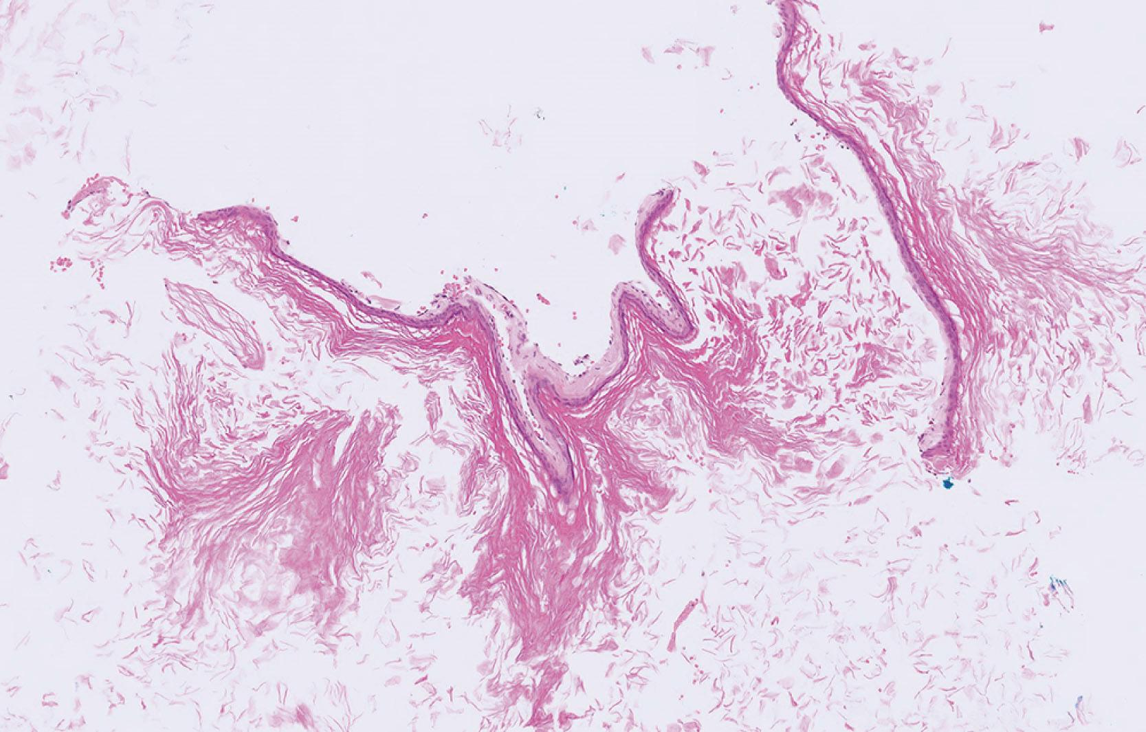 e-Fig. 21.1, Cholesteatoma (MP)