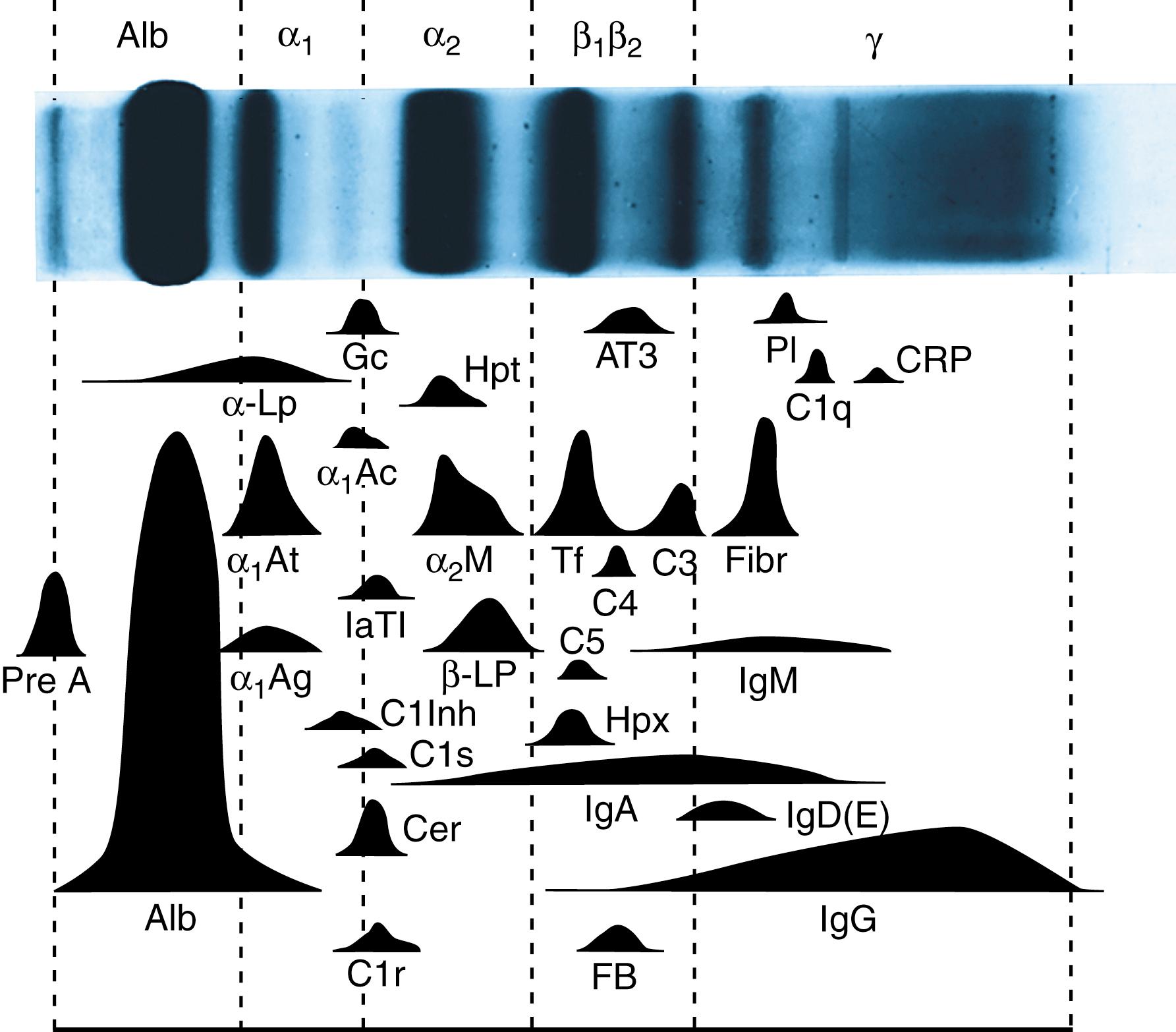 Figure 20.2, Plasma protein electrophoresis pattern in agarose gel is composed of five fractions, each composed of many individual species. Some of the major proteins are shown here in an artist’s rendition for clarity. α 1 Ac, α 1 -Antichymotrypsin; α 1 Ag, α 1 -acid glycoprotein; α 1 At, α 1 -antitrypsin; α 2 -M, α 2 -macroglobulin; α-Lp, α-lipoprotein; Alb, albumin; AT3, antithrombin III; β-Lp, β-lipoprotein; complement components C1q, C1r, C1s, C3, C4, C5, as designated; C1Inh, C1 esterase inhibitor; Cer, ceruloplasmin; CRP, C-reactive protein; FB, factor B; Fibr, fibrinogen; Gc, Gc-globulin (vitamin D–binding protein); Hpt, haptoglobin; Hpx, hemopexin; immunoglobulins IgA, IgD, IgE, IgG, IgM, as designated; I α TI, inter-α-trypsin inhibitor; Pl, plasminogen; Pre A, prealbumin; Tf, transferrin. (Modified from Laurell CB: Electrophoresis, specific protein assays, or both in measurement of plasma proteins? Clin Chem 19:99, 1973, with permission.)