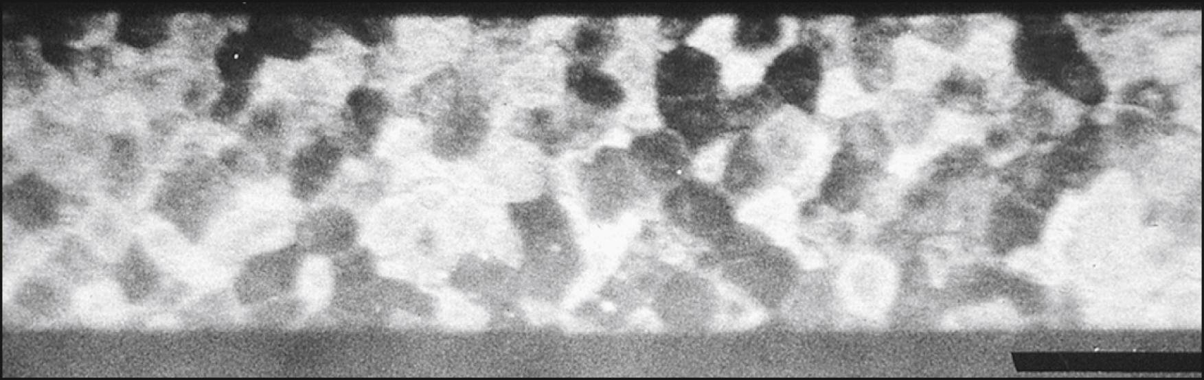 Fig. 13.5, Specular image of normal corneal epithelium. Note that there are three kinds of cells: dark cells, intermediate cells, and bright cells. No rounded or elongated cells are seen. The bar represents 100 μm.