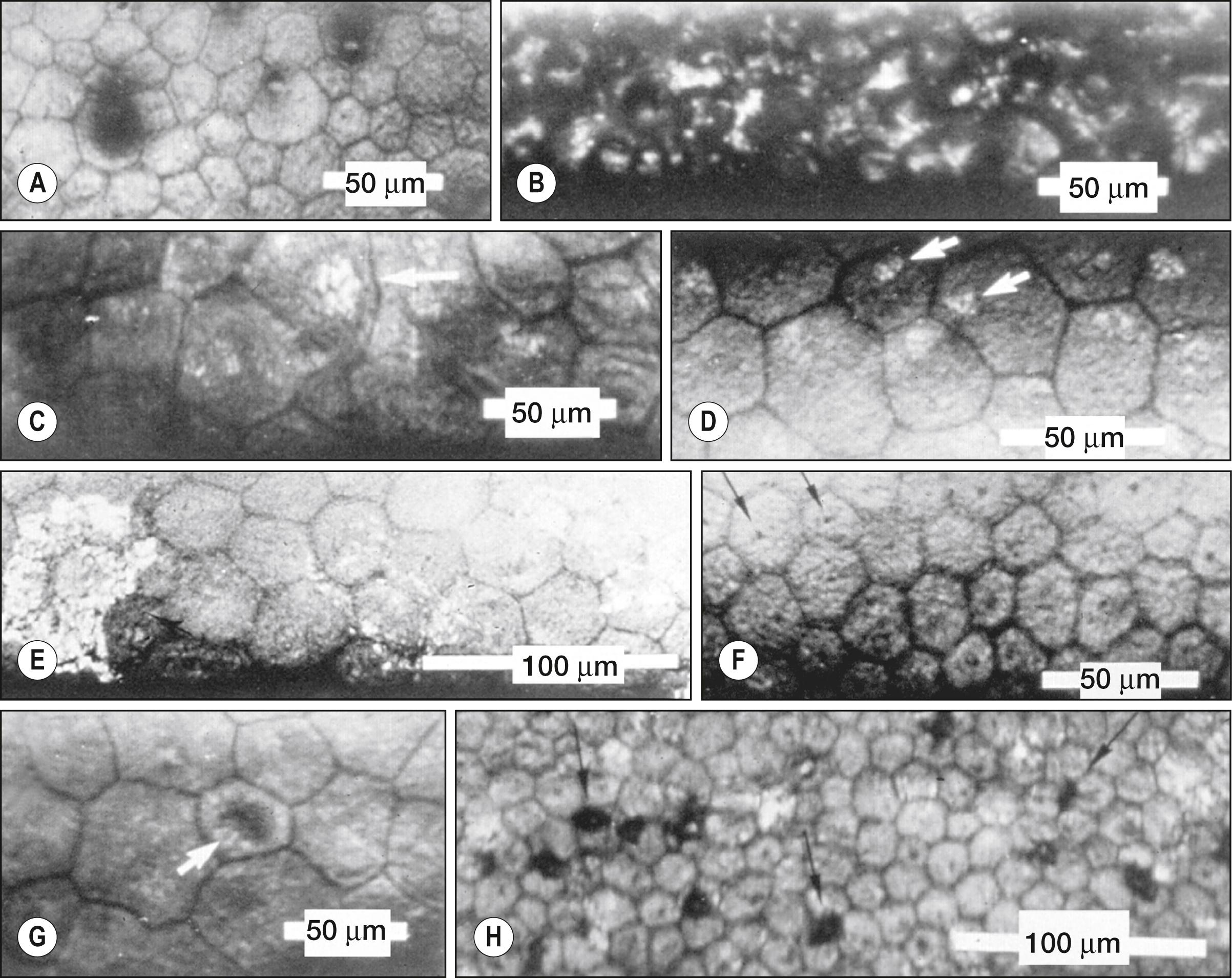 Fig. 13.6, Miscellaneous endothelial structures. Arrows indicate features mentioned. ( A ) Isolated smooth excrescences (corneal guttae). ( B ) Multiple coalesced excrescences. Only the bright reflection from the apex of each excrescence is clearly seen. ( C and D ) Intracellular bright structures possibly representing cell nuclei. ( E ) Pigmented endothelial deposits. ( F ) Dark structures possibly representing endothelial cilia. ( G ) Intracellular dark structures possibly representing intracellular vacuoles. ( H ) Intercellular dark structures believed to be invading inflammatory cells.