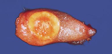 Fig. 14.2, Heterotopic adrenal cortical tissue in the left spermatic cord forming a discrete yellow-orange nodule.