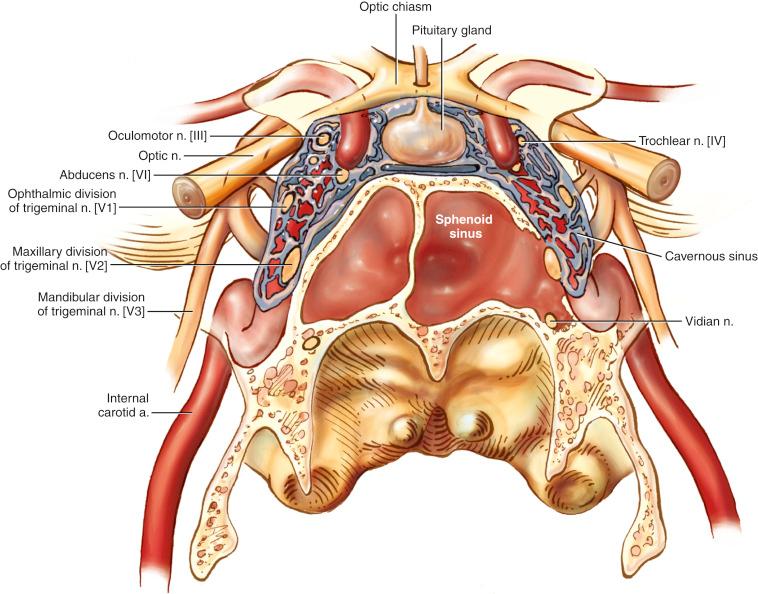 Fig. 27.1, Drawing of a coronal cross-section through the sphenoid sinus and associated structures. Note that loss of bone is depicted over the patient’s left cavernous sinus, V2, vidian nerve, and carotid artery as can often present with encephaloceles. a., Artery; n., nerve.