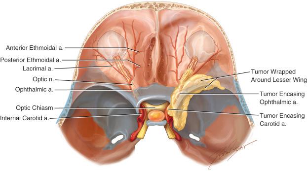 Figure 32.1, Superior-oblique view of a skull. Representation of a typical medial sphenoid wing meningioma. The sphenoid bone is highlighted in blue. The tumor is encasing the optic nerve, cavernous sinus and internal carotid artery.