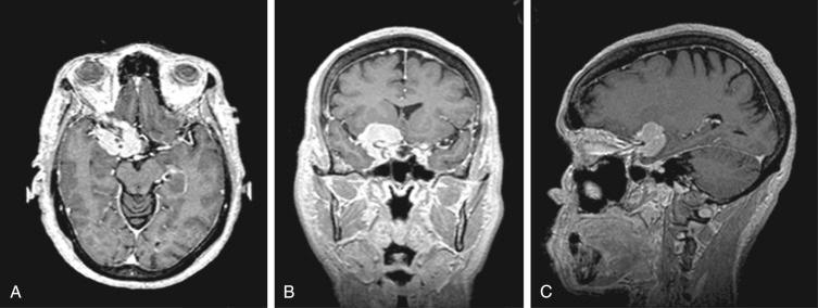 Figure 32.2, Radiological findings for a medial sphenoid wing meningioma. Contrast enhancing lesion at the right sphenoid wing encasing the neurovascular structures. (A) T1-weighted axial view. (B) T1-weighted coronal view. (C) T1-weighted sagittal view.