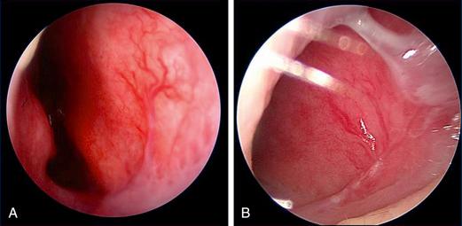 Fig. 3.2, (A) and (B) Endoscopic views of the Kiesselbach plexus in the Little area.