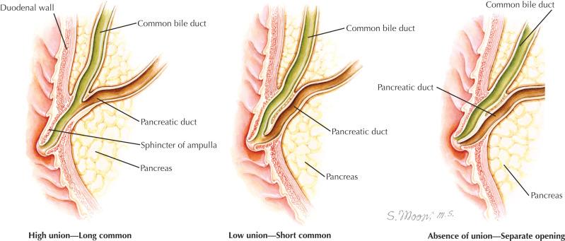Fig. 139.1, Variations in Ductal Anatomy in Sphincter of Oddi Dysfunction.