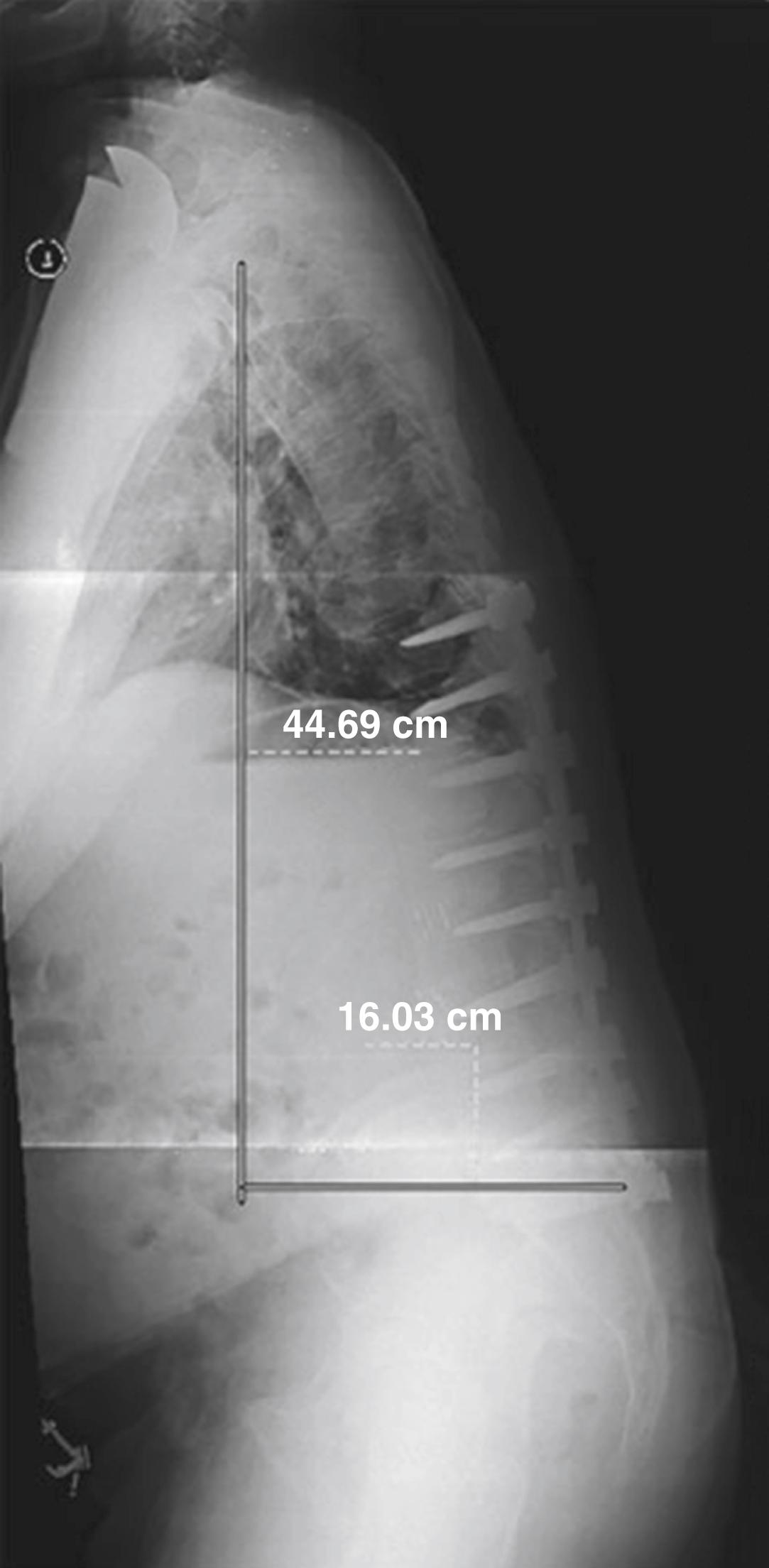 Fig. 63.2, Lateral scoliosis x-ray of a 72-year-old man after a T10‒S1 posterior spinal fusion. The sagittal vertical axis is defined as the horizontal offset from the posterosuperior corner of S1 to the vertebral midbody of C7 (C7 plumb line).