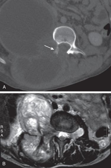 Figure 41.2, Malignant peripheral nerve sheath tumor in a 16-year-old with neurofibromatosis.