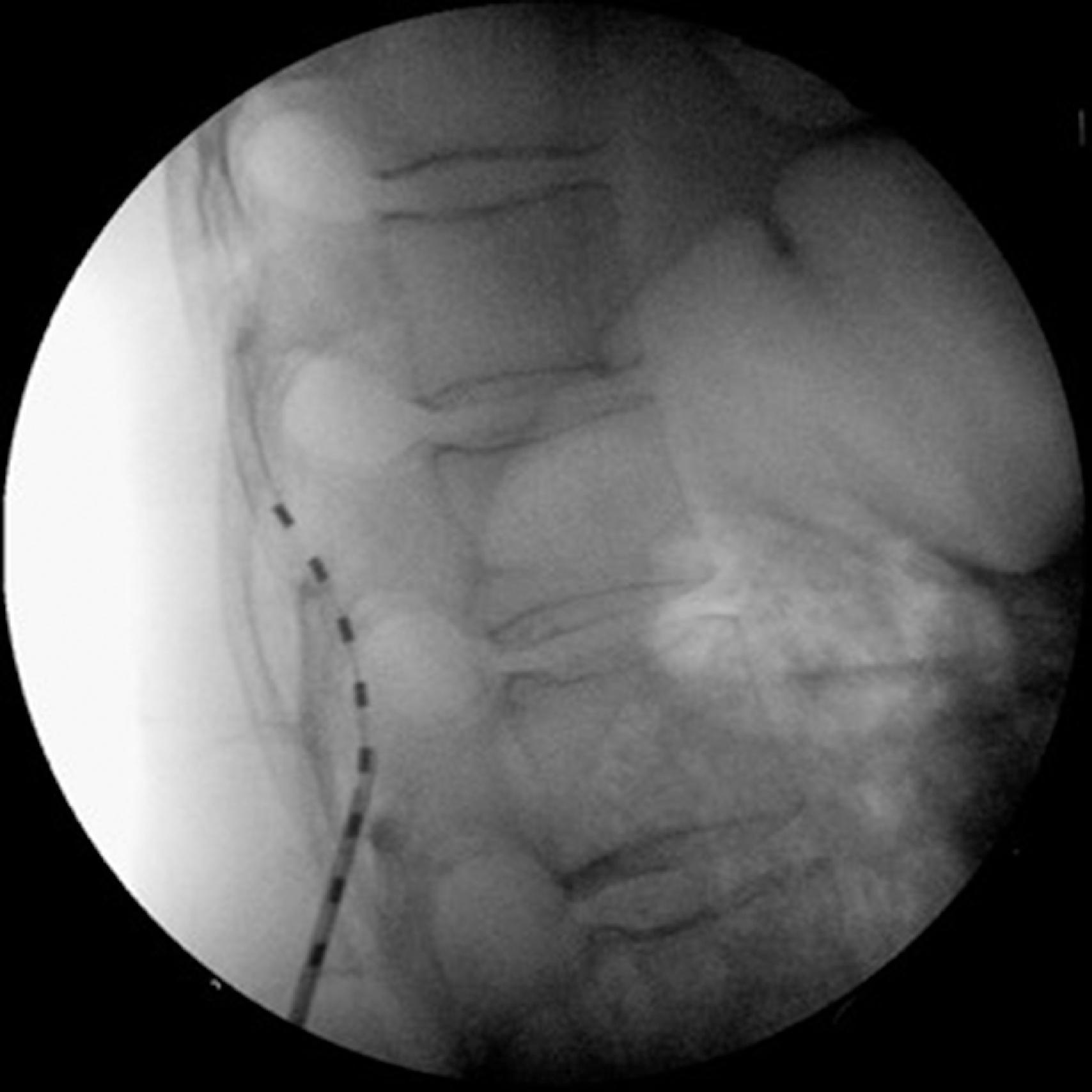 Figure 71.1A, Lateral fluoroscopic view illustrating interlaminar needle entry into the epidural space with eight contact spinal cord stimulation lead threading into the posterior epidural space. Note that undesirable anterior migration of the lead in the lateral fluoroscopic view would be evident if the lead were visualized running adjacent to the vertebral bodies at the anterior border of the neural foramen. Figure 71.1B Anterior-posterior fluoroscopic view of two eight-contact spinal cord stimulation leads in the midline, parallel orientation. Note the staggering of lead contacts to obtain maximal coverage from the top of T8 (left lead) to the top of T11 (right lead) vertebral bodies.