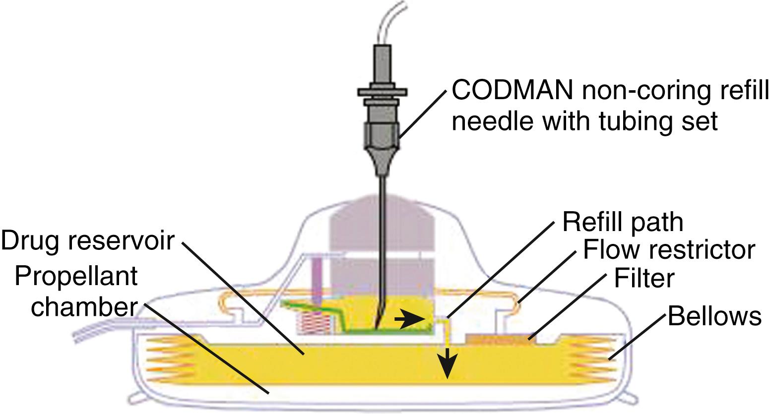 FIGURE 120.2, Advancement of cylindrical electrode through an epidural needle. Note that steering the electrode is possible by rotating the stylet hub of the electrode.