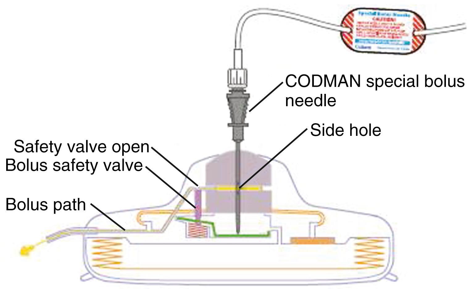 FIGURE 120.3, Quadripolar electrode being advanced under fluoroscopic guidance within the epidural space. Note the angle between the two most cephalad leads enabling steering of the electrode.