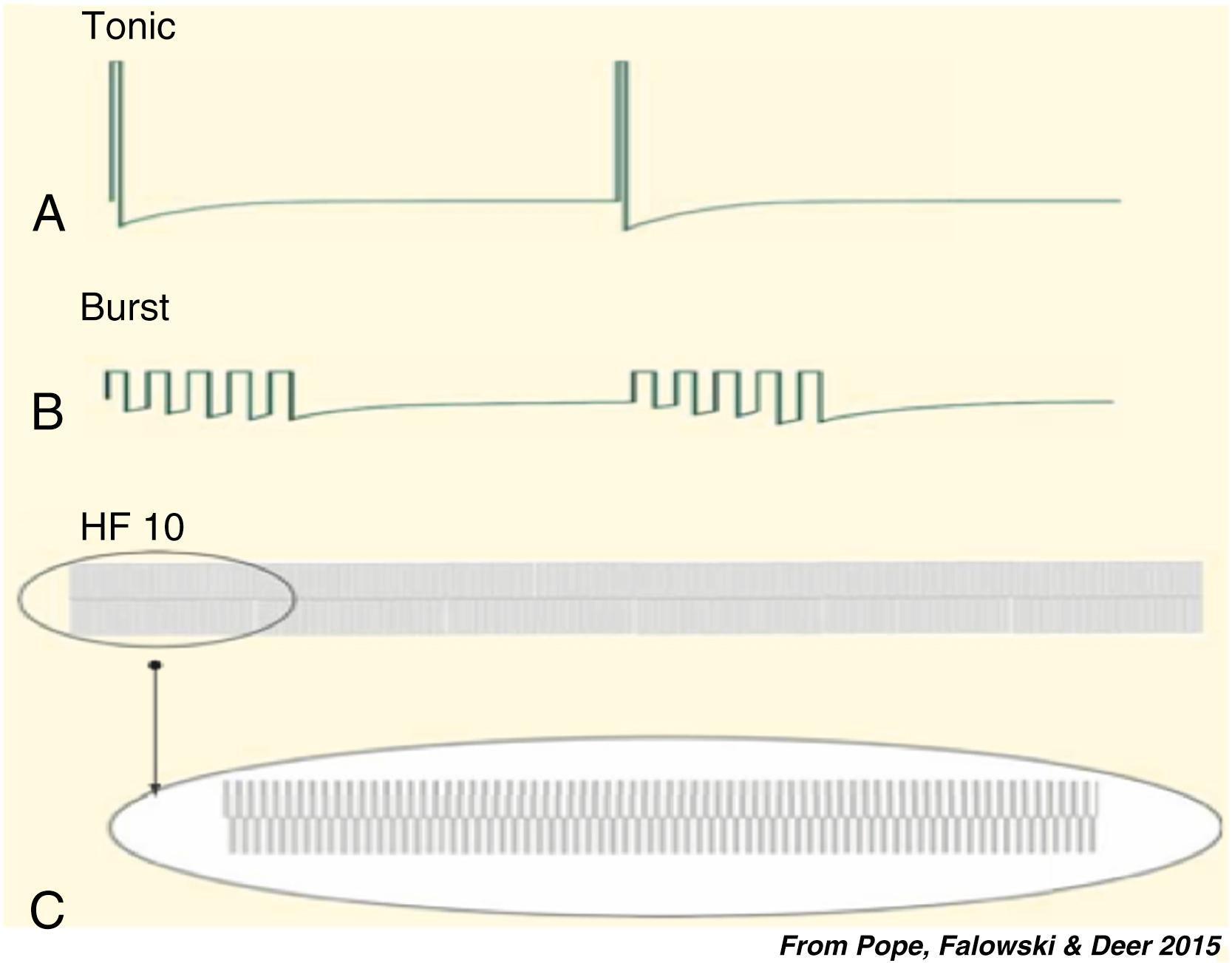 FIGURE 119.1, During the past decade, new spinal cord stimulation (SCS) waveforms have been introduced, supplementing or replacing conventional tonic stimulation (A). Among them are Burst SCS: with groups of five pulses (internal frequency 500 Hz) applied with a frequency of 40 Hz (B) and high-frequency stimulation (HF SCS) : with frequencies up to 10,000 Hz (10 KHz) (C).