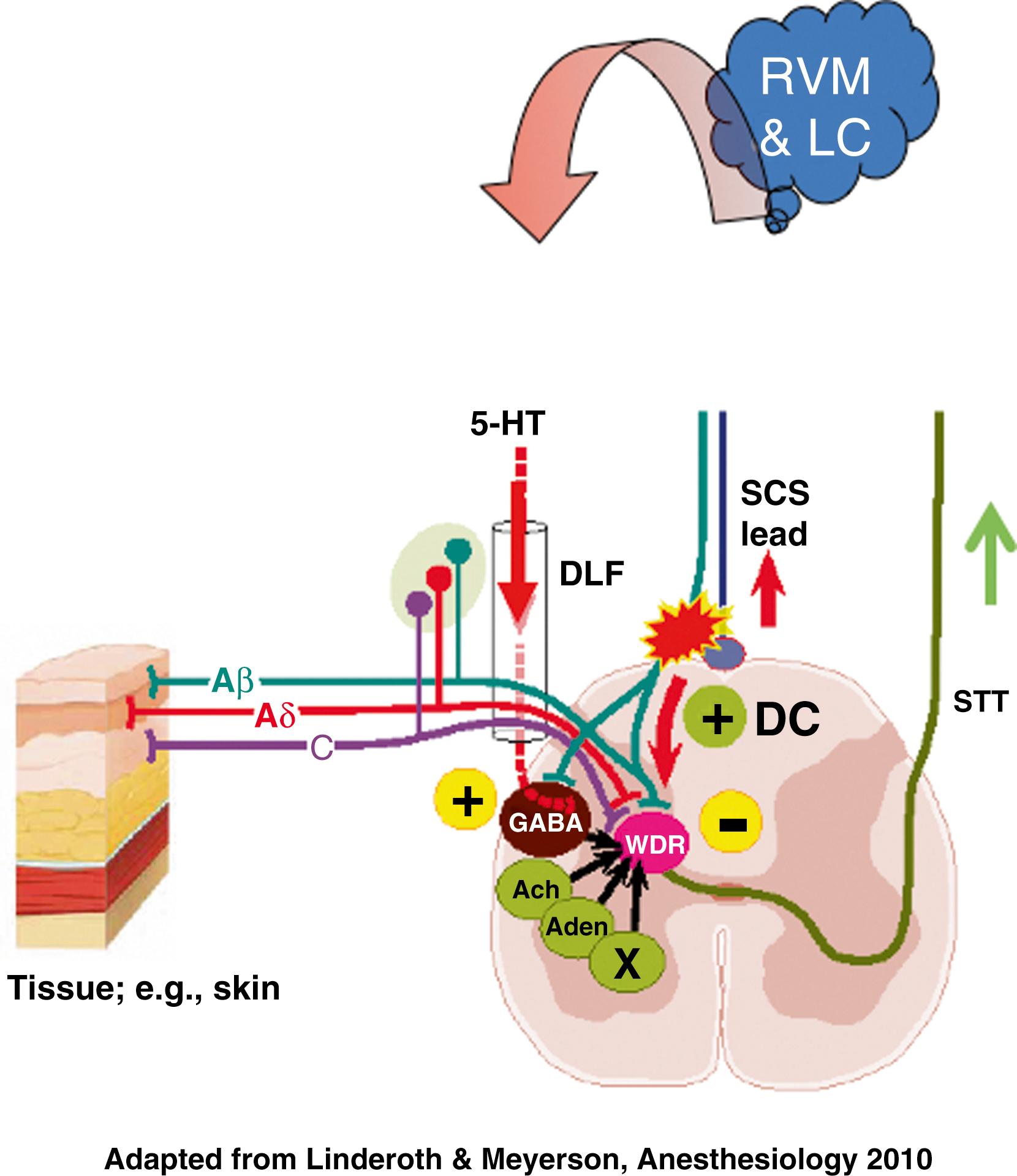 FIGURE 119.3, The present knowledge of the neural circuitry and transmitters involved in conventional spinal cord stimulation (SCS) , when applied for neuropathic pain.