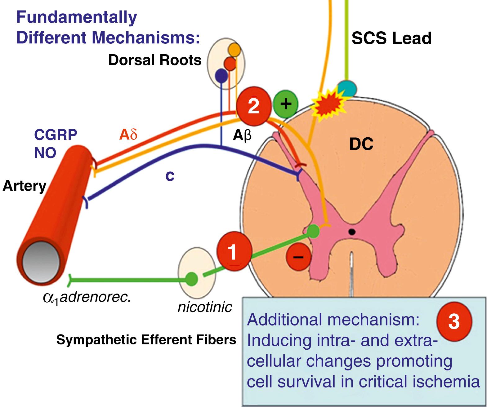 FIGURE 119.4, This figure summarizes the major mechanisms considered to be activated by SCS and which eventually may lead to decrease of ischemic pain by diminishing the tissue ischemia. Pharmacological studies demonstrated (1) the pivotal role of SCS-induced reduction of sympathetic efferent vasoconstrictor activity (mainly via ganglionic nicotinic receptors and a 1 adreno-receptors at the neuro-effector junction). Further studies demonstrated that (2) SCS (also at low intensities) activated dorsal root fibers antidromically leading to a peripheral release of CGRP and a peripheral formation of nitric oxide both of which contribute to vasodilatation. There are probably (3) other mechanisms producing a post-SCS resistance to effects of ischemia but these are at present not well understood.