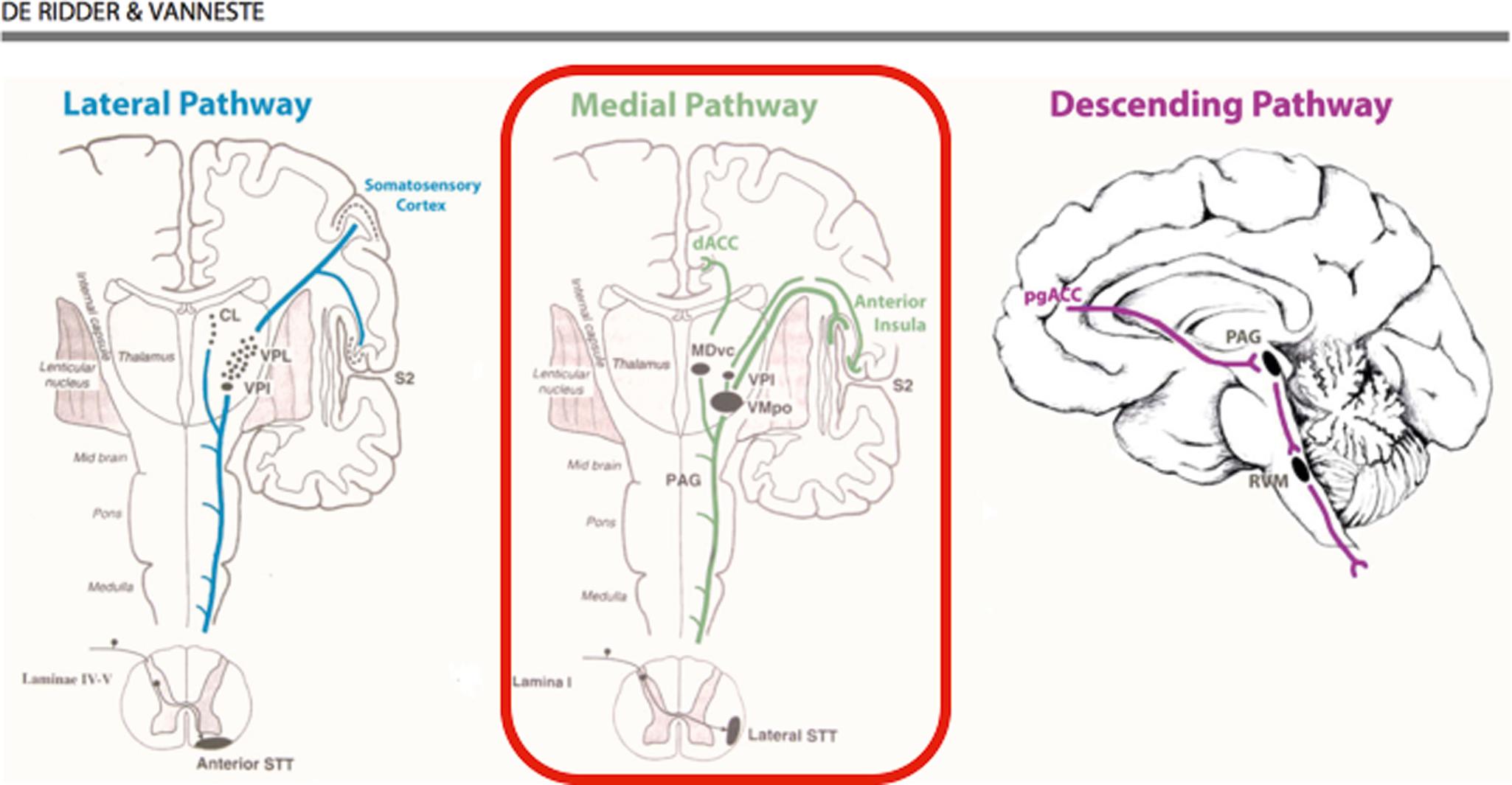 FIGURE 119.5, Present “working hypotheses” for mechanisms behind effects of burst stimulation of the spinal cord (presented by De Ridder & Vanneste in several articles e.g., Neuromodulation Nov 2015) during the last decade: Burst SCS is hypothesized to especially modulate the activation of the medial (affective/attentional) pathway (in the middle of the figure (encircled). On the contrary the anterior spinothalamic pathway mainly activates the lateral (sensory) pathway (left part of figure). The right figure illustrates some of the descending pathways via the PAG and the RVM.