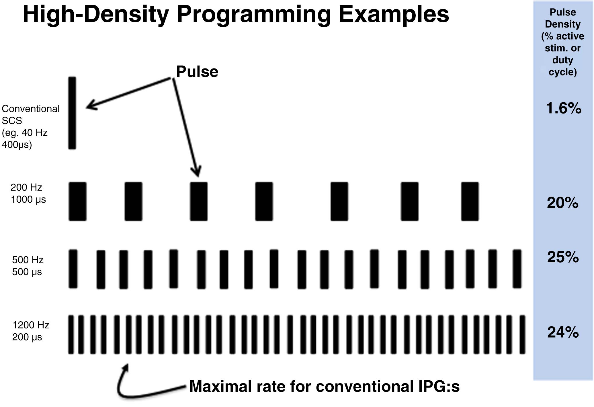 FIGURE 119.7, Illustrates how increases of the stimulation frequency result in higher pulse densities. It is evident that the conventional SCS settings produce a low pulse density while the lower parts of the picture with settings of 500 Hz/500 μsec or 1200 Hz and 200 μsec can produce pulse densities between 24-25% even with subparestetic amplitudes. This opens a set of new stimulation routines for many patients.