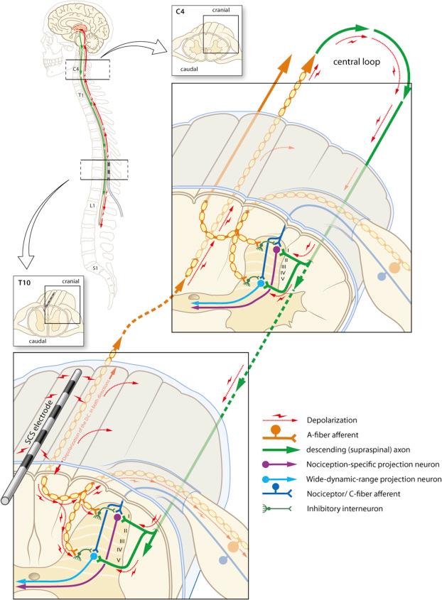 Figure 49.3, The spinal nociceptive network and mechanism of SCS.