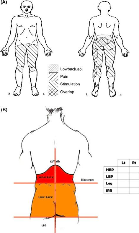 Figure 50.1, When low back pain (LBP) is defined explicitly, using pain drawing methodology, (A) coverage by spinal cord stimulation paresthesia can be documented clearly and even quantified and (B) variability of the definition of LBP between studies may be appreciated.