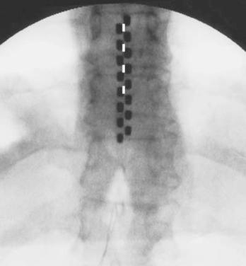 Figure 50.3, In a comparative study of two electrode designs, a percutaneous 4-contact electrode trial was followed by implantation via laminotomy of a 2-column, 16-contact paddle electrode at the same level in each patient, and quantitative comparisons of low back paresthesia coverage were made, scaled to the amplitude range defined in Fig. 50.2 . Two radiographs from one representative patient are combined here.