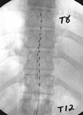 Figure 50.5, Two 8-contact percutaneous electrodes placed in the radiographic midline, one above the other, to span the T8-11 vertebral bodies and deliver 10 kHz stimulation for low back pain.