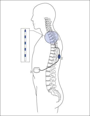 Figure 41-2, Schematic overview of a spinal cord stimulation system.