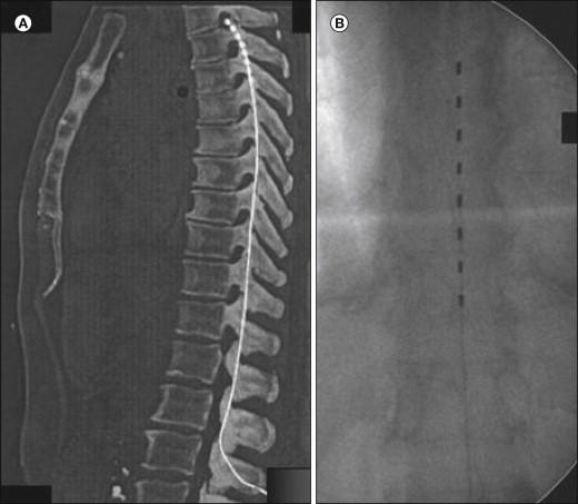 Figure 41-3, Radiographs showing percutaneously implanted octapolar electrode leads in a lateral projection imaged by spiral computed tomography ( A ) and in a frontal x-ray projection ( B ).