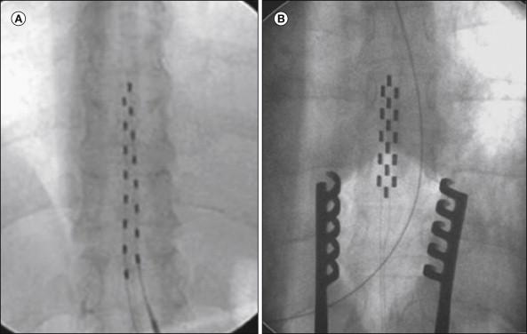 Figure 41-4, Radiographs of different types of electrodes.