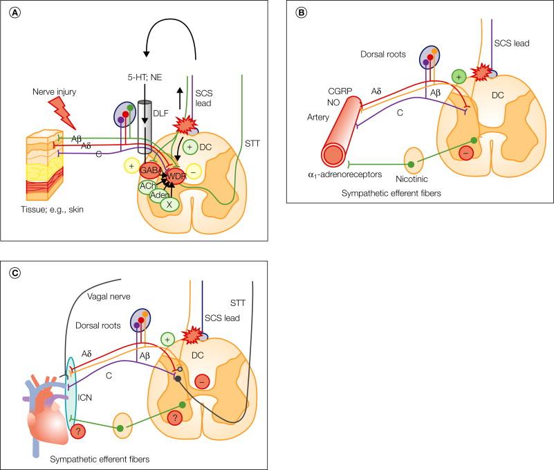 Figure 41-6, A, Schematic representation of some of the mechanisms involved in spinal cord stimulation when applied as treatment of neuropathic pain. Activation of dorsal column fibers transmits impulses orthodromically, thereby giving rise to paresthesias, and antidromically via collaterals to target regions in the dorsal horns. The antidromic impulses activate multiple inhibitory mechanisms, some of which have been studied in experiments on nerve-injured rats with tactile hypersensitivity, or “allodynia.” Some dorsal horn interneurons release γ-aminobutyric acid (GABA), which in turn decreases release of the excitatory amino acids glutamate and aspartate following spinal nerve stimulation (SCS) in nerve-lesioned rats. Another interneuron system accounts for the release of acetylcholine (ACh), which contributes to the inhibition by activation of, in particular, muscarinic M 4 receptors. Adenosine (Aden) may play a role similar to that of GABA and ACh. The orthodromic dorsal column impulses activate centers in the brain stem that are the origin of descending pathways to the various spinal segments, where release of norepinephrine (NE) and serotonin (5-HT) exerts an inhibitory influence on sensitized local projection neurons. There are indications that activation of GABA interneurons is also involved in some part in this “descending” inhibition. It is conceivable that numerous hitherto unknown transmitters and modulators are also involved in the modulation (represented by “X”). B, Schematic representation of the putative effects of SCS when applied as treatment of pain in ischemic diseases. SCS produces vasodilation of the peripheral vasculature and may (1) reduce the activity of spinothalamic tract cells (less probable in the clinical setting), (2) decrease the activity of sympathetic preganglionic neurons, (3) reduce the release of norepinephrine from sympathetic post-ganglionic neurons, and (4) antidromically activate dorsal root afferent fibers to produce local release of calcitonin gene–related peptide (CGRP) and nitric oxide (NO). C, SCS when applied for the treatment of pain in ischemic heart disease may (1) reduce the activity of spinothalamic tract (STT) cells in the short term (less probable in the clinical setting), (2) reduce ischemia (via mostly unknown mechanisms), (3) modulate the activity of sympathetic preganglionic neurons, and (4) stabilize the intrinsic cardiac nervous system (ICN). In addition, a protective effect on ischemic cardiomyocytes related to local release of catecholamines has recently been demonstrated (see text). DC, dorsal column; DLF, dorsolateral funiculus; WDR, wide dynamic range neuron.