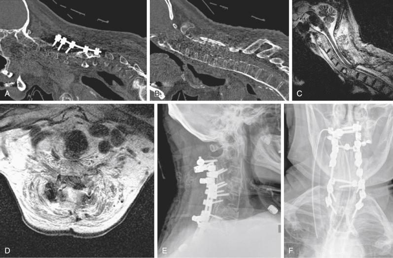 FIGURE 51-2, An 84-year-old man with ankylosing spondylitis who fell and sustained a C6 fracture requiring stabilization. Subsequently, his instrumentation failed ( A and B ), so he was taken to the operating room for revision instrumentation. However, during positioning but after fiberoptic intubation, the patient was noted to have a complete drop in his motor-evoked potentials to bilateral lower extremities. Therefore, he was taken on an emergency basis to the magnetic resonance imaging (MRI) scanner to evaluate for any spinal cord compression and target a decompression. MRI revealed severe spinal canal compromise ( C and D ). Therefore, the patient was taken back to the operating room for decompression and revision instrumentation ( E and F ). Postoperatively, he was maintained on mean arterial pressure requirements, steroids were initiated, and a halo was placed to support the fixation. His postoperative neurologic examination revealed full strength and sensation.