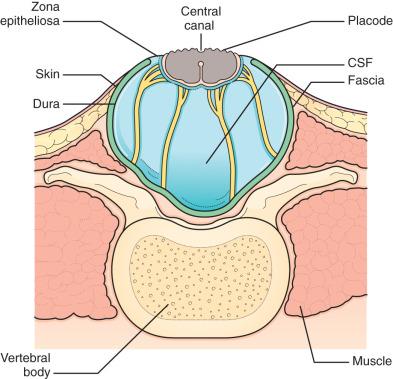 Figure 7.2, Cross-sectional anatomy of a myelomeningocele. The neural placode is visible on the back, usually at the center of the sac. It is separated from the full-thickness skin by a fringe of pearly tissue, the “zone epitheliosa.” The neural tissue herniates through a defect in the skin, fascia, muscle, and bone. The dorsal dura and zona epitheliosa converge to attach laterally to the placode, forming the roof of the sac.