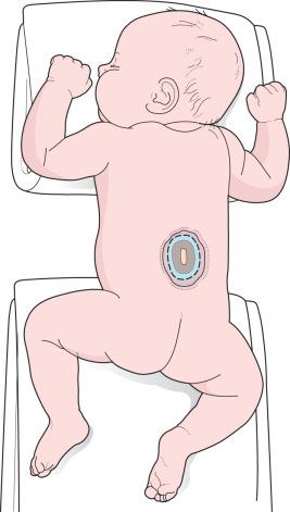 Figure 7.3, Positioning the patient for myelomeningocele closure. The infant is placed in the prone position, with rolls beneath the chest and iliac crests to minimize epidural bleeding. The skin incision is outlined circumferentially on the outside of the zona epitheliosa. A vertical orientation of the elliptical incision is appropriate for most closures.