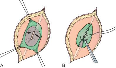 Figure 7.4, (A) Mobilizing and closing the dura. (B) The dura is undermined and closed using a continuous 4-0 nonabsorbable suture.