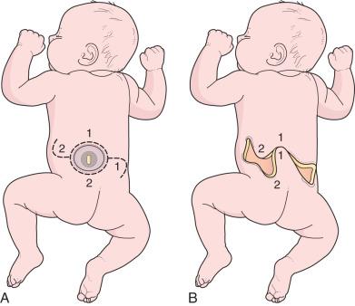 Figure 7.6, Simple rotation flap. (A) An S-shaped horizontal incision is made, encompassing the circular defect. (B) The points are approximated to the hollows, relieving tension both vertically and horizontally. The resulting skin closure has a W shape.