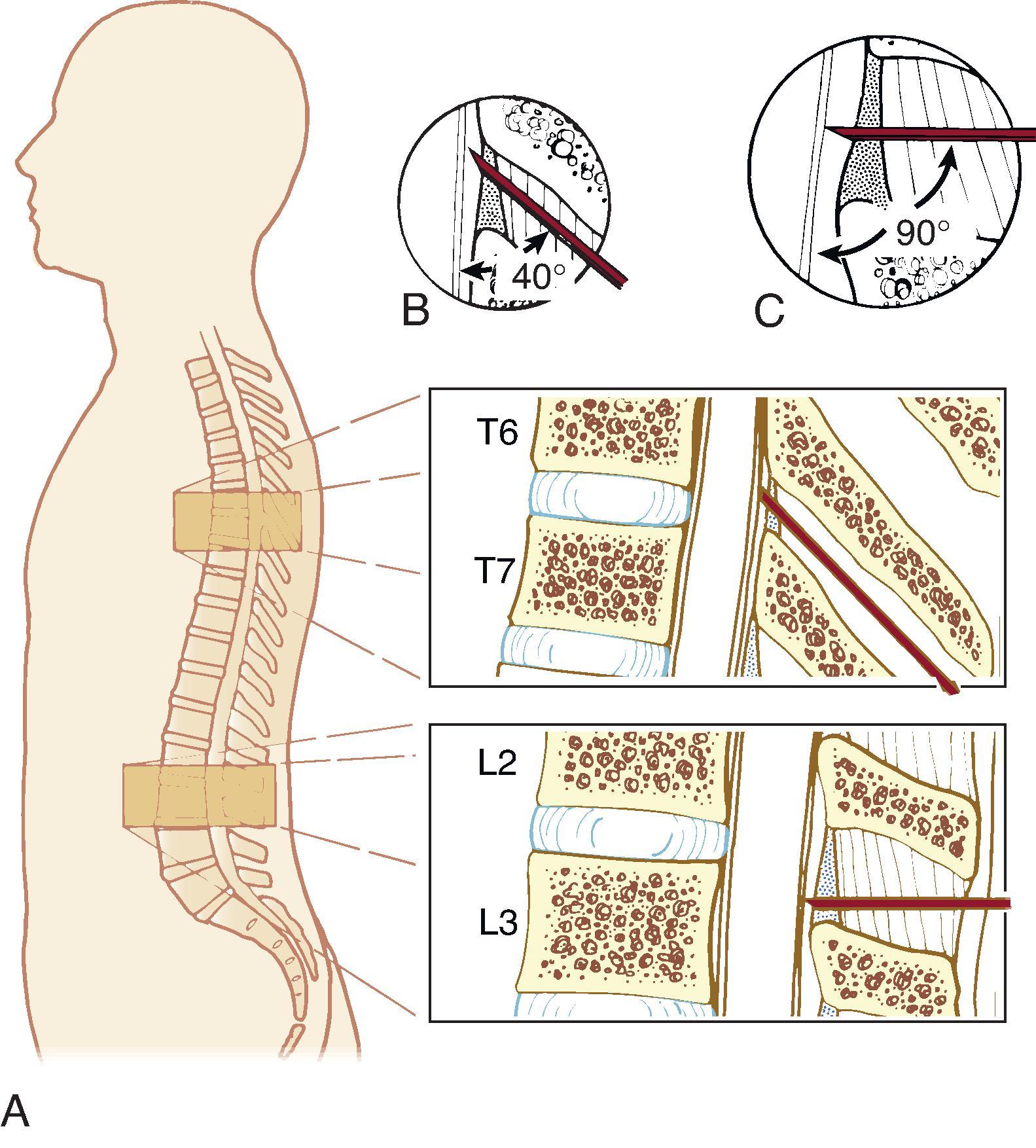 Fig. 17.5, Lumbar and thoracic epidural technique. The cephalad (acute) angle of needle insertion during thoracic epidural cannulation may provide a slightly longer distance of “needle travel” before entering the epidural space (A). In contrast, during lumbar epidural cannulation (B) the distance traveled is modified by a more perpendicular angle of needle insertion (C). (From Brull R, Macfarlane AJR, Chan VWS. Spinal, epidural and caudal anesthesia. In Miller RD, Cohen NH, Eriksson LI, et al, eds. Miller's Anesthesia. 8th ed. Philadelphia: Saunders Elsevier; 2015:Fig. 56.9.)