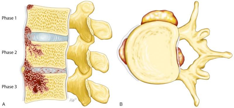 eFIGURE 66–1, Parasagittal and axial representation of spinal infection, a classic pattern of pyogenic infectious spondylodiskitis. The initial focus of infection is often situated in a vertebral body edge, and there is often a small thromboembolic occlusion of an endartery with local inflammation (phase 1). From here, the infection can spread further into the vertebral body and into adjacent anatomic spaces. It often spreads underneath a longitudinal ligament to the adjacent vertebra and begins to invade the disk space (phase 2). Disk space invasion leads to disk destruction with loss of height, often the earliest radiographic sign of infection. The infection continues to spread into the vertebral bodies involved, and bone destruction and reactive sclerotic change may become visible (phase 3). On axial imaging, spread of infection to the paravertebral space might be visible. This leads to invasion of the retroperitoneal space. Immediately ventral to the spine is typically minor involvement. Lateral spread to the psoas muscles often leads to abscess formation. Involvement of the epidural space with phlegmon and abscess formation can lead to severe but ill-defined neurologic symptoms. As soon as this space is involved, the infection can spread relatively easily in the epidural space cranially and caudally, seeding further foci of epidural infection in the spinal canal.