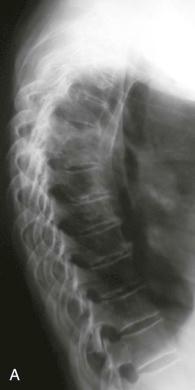 FIGURE 66–2, A 69-year-old woman with pyogenic infection of T5 and T6 vertebral bodies with epidural abscess formation. A lateral radiograph ( A ) demonstrates disk and end-plate destruction. B-E , MRI shows bone marrow edema and epidural abscess formation causing cord compression (STIR, T2-weighted, T1-weighted, and T1-weighted with contrast enhancement, respectively). The epidural abscess is best appreciated on T2-weighted images. There is involvement of the anterior inferior edge of the T4 vertebral body. Antibiotic drug therapy was instigated. F-H , One month later (T2-weighted, T1-weighted, and T1-weighted with contrast enhancement, respectively), the epidural abscess has decreased in size, but the spinal cord shows an abnormal high signal in the T2-weighted image, in F . The patient now was paraplegic, and the function did not recover. I-K , Further follow-up imaging 3 months later (T2-weighted, T1-weighted, and T1-weighted with contrast enhancement, respectively) shows regression of the epidural abscess but progression of bone destruction. Contrast enhancement is reduced indicating reduction of inflammation. L-M , Two years later (T2-weighted and T1-weighted, respectively), there is complete healing, with fusion of the T5 and T6 vertebral bodies, both are reduced in height, and there is also anterior fusion to the T4 vertebral body. STIR, Short tau inversion recovery.