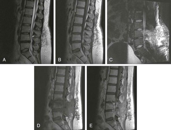 FIGURE 66–3, A 48-year-old diabetic woman with discogenic back pain. A and B , Postoperatively, persistent leg pain and weakness, postoperative MRI shows normal postoperative change only (sagittal T2-weighted and T1-weighted with postcontrast medium enhancement, respectively). Worsening leg weakness leads to explorative surgery a few days later. The leg weakness remained, and pyrexia developed. Repeat MRI 8 days after the first postoperative MRI is degraded by movement artifact due to severe pain and shows developing bone marrow edema at the L3 and L4 levels (STIR) ( C ). Further surgical exploration revealed large amounts of pus. The patient was very slow to improve; further follow-up MRI 3 months later showed evidence of spondylodiskitis at the L3 to L4 and L4 to L5 levels (T1-weighted) ( D ) and T1-weighted postcontrast enhancement images ( E ). Postoperative infection can be difficult to diagnose early due to postoperative changes. Clinical suspicion and inflammatory parameters can be more valuable than imaging. If clinical suspicion is high, a repeat MRI 1 or 2 weeks after an initial normal examination is indicated and might show evidence of infection. STIR, Short tau inversion recovery.