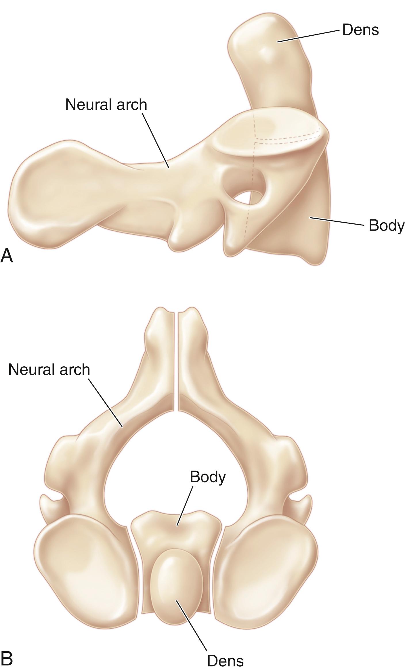 Fig. 28.2, Schematic sagittal (A) and axial (B) views of the ossification centers of the axis. The four centers of ossification are depicted. The anterior arch is comprised of the body and the dens, whereas two neural arches comprise the remaining centers of ossification.