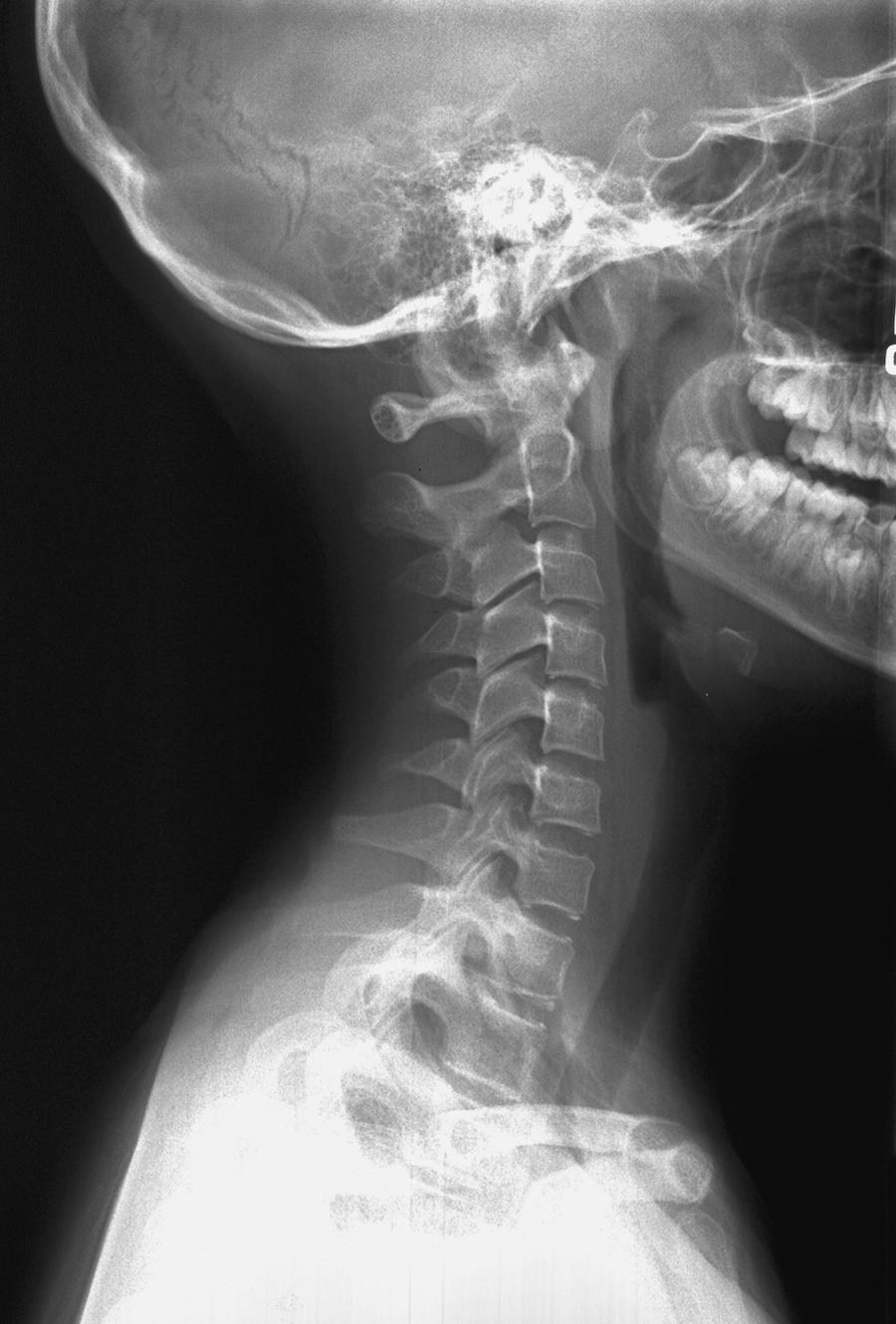 Fig. 28.3, Screening lateral radiograph of the cervical spine. The radiograph should show all seven cervical vertebrae and also include the C7–T1 level.